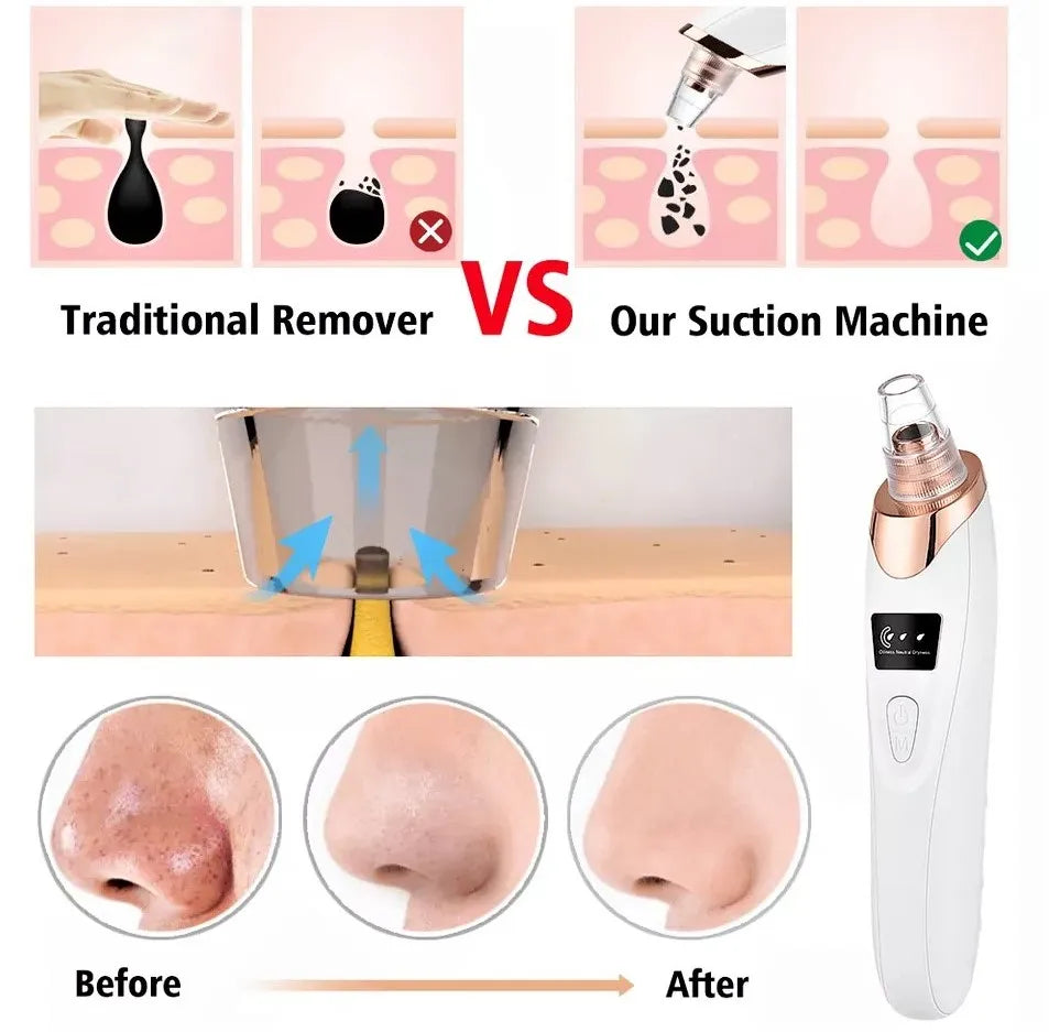 5in1 Blackhead Remover